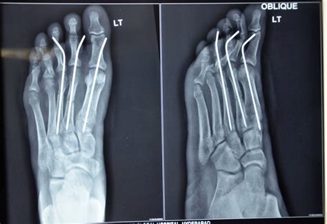 Crush Injury Foot Lower Limb Injuries And Limb Salvage Bilateral