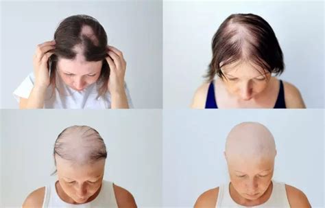 Female Pattern Baldness Stages Symptoms Causes And Treatment