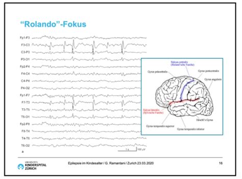Neurologie Fokale Epilepsien Und Syndrome Amboss Flashcards Quizlet