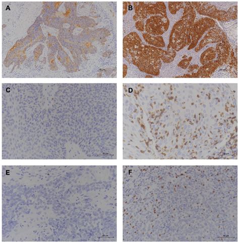 Representative Images Of Immunohistochemical Staining Of Snscc Tissue