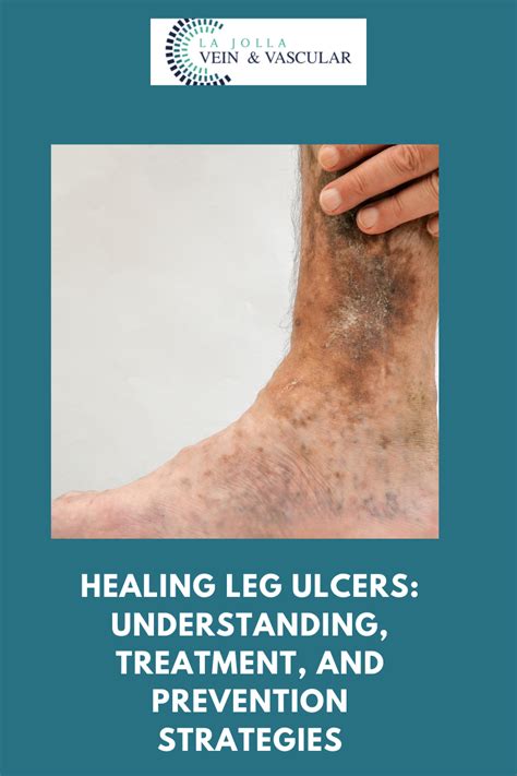 Leg Ulcers Treatment Vein And Vascular Care Clinic