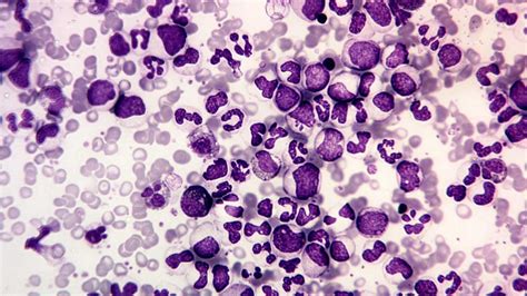 Chronic Myeloid Leukemia Cml T922 Symptoms And Diagnosis