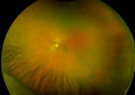 Retinal Holes and Tears - Recognizing Pathology - Optos