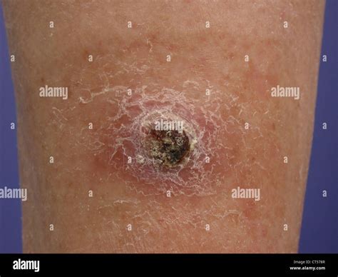Squamous Cell Carcinoma Hi Res Stock Photography And Images Alamy