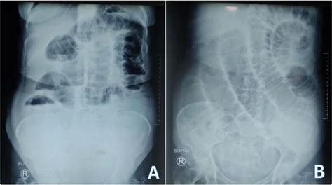 Plain Abdominal X Ray Erect A And Supine B View A Multiple Air