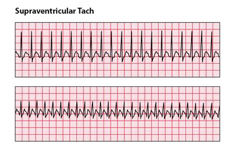 Some patients are unaware that their heart is beating quickly. Psvt Ecg / Supraventricular Tachycardia Wikivisually ...