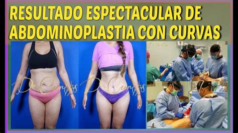 Abdominoplastia Antes Y Despu S Dr Cortes En Houston Tx Youtube