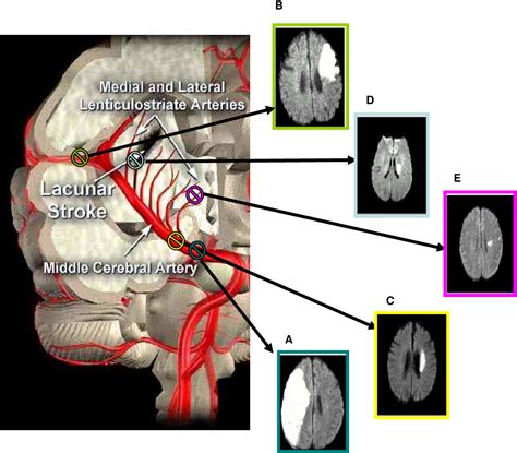 Figure From Pathophysiology Of Lacunar Stroke Ischaemic Stroke Or Blood Brain Barrier