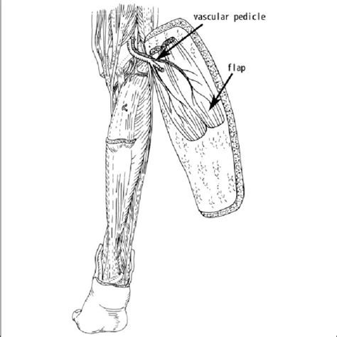 Raising Of The Gastrocnemius Myocutaneous Flap Pedicled With The