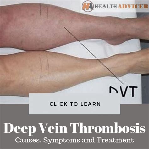 Deep Vein Thrombosis Causes Picture Symptoms And Treatment