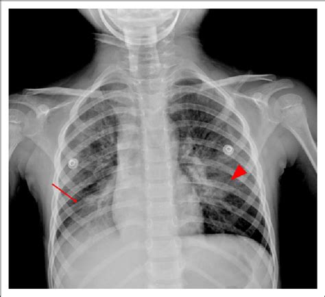 Chest Radiograph Showing Pneumonic Consolidation In The Right Lower Download Scientific Diagram