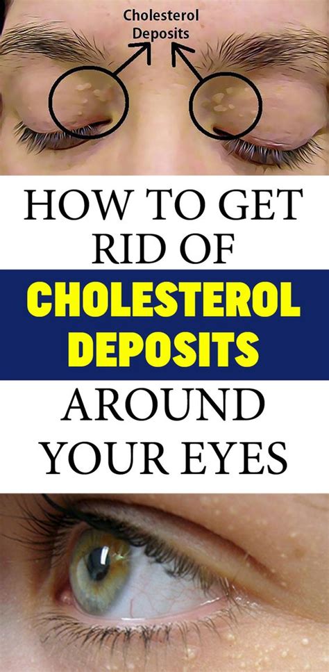 How To Remove The Cholesterol Deposits Around Your Eyes Healthy Safely