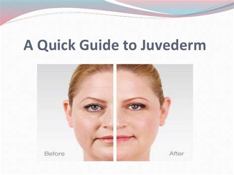 A Quick Guide To Juvederm