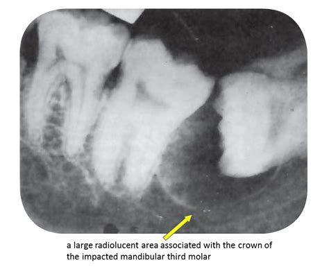 Dentosphere World Of Dentistry Dentigerous Cyst Follicular Cyst