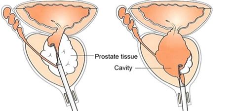 Transurethral Resection Of Prostate Turp Gm Urology