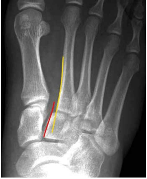 Some injuries cause only mild swelling and pain in the midfoot. Anteroposterior foot x-ray demonstrating Lisfranc injury ...