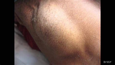 Huge Swelling In Axilla Youtube
