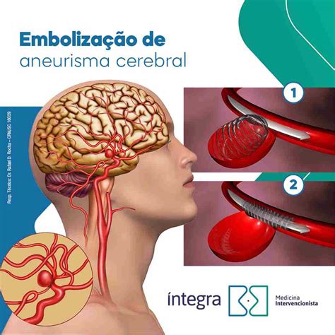 Embolização de aneurisma cerebral Medicina Intervencionista