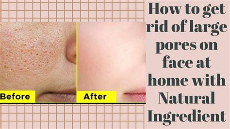 Large Pores Tips N Tricks How To Minimise Pores On Face Easily