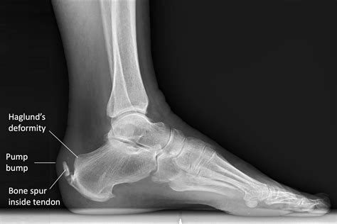 Top More Than Achilles Heel Bone Spur Treatment Super Hot Esthdonghoadian