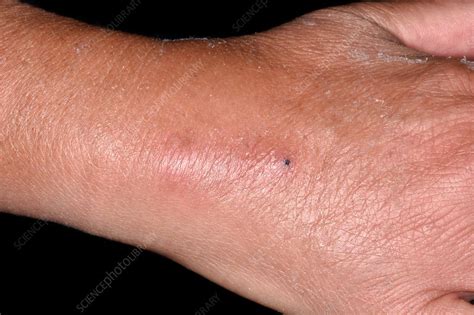 Inflammation At Intravenous Cannula Site Stock Image C0370947