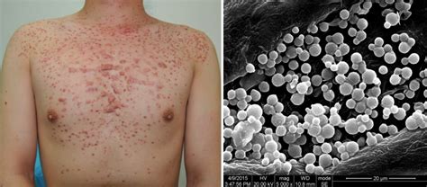 What Is The Difference Between Bacterial And Fungal Folliculitis