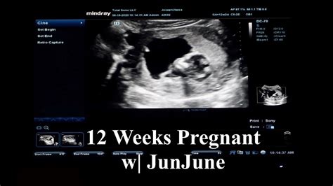 12 Weeks Pregnant Blackjerseylove Full Ultrasound Baby Heartbeat