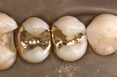 Gold Cast Inlays And Onlays Bozeman Mt Dr Smith