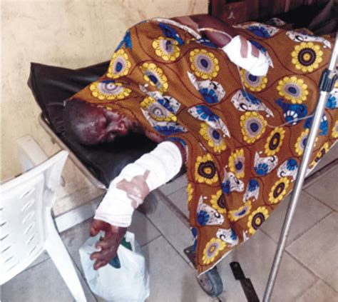 Fulani Herdsmen Attack Farmer Cut Arm The Hope Newspaper