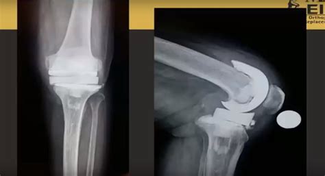 Revision Total Knee Replacement —