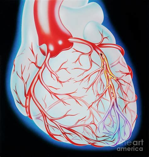 Coronary Artery Occlusion In Heart Attack Photograph By John Bavosi