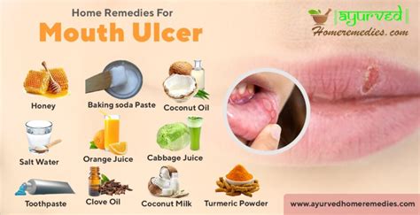 Home Remedies To Cure Mouth Ulcers How To Get Rid Of Canker Sores