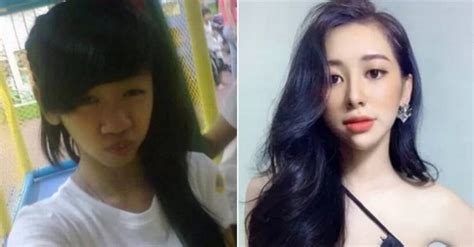 Vietnamese Girl Undergoes Radical Plastic Surgery After A Breakup With