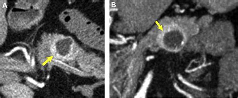 Incidental Pancreatic Cysts On Cross Sectional Imaging Radiology Key