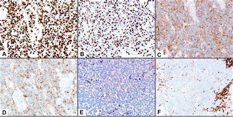The following tests are used to identify merkel cell carcinoma, and to determine its stage (how far the disease has. Immunohistochemical profile of Merkel cell carcinoma ...