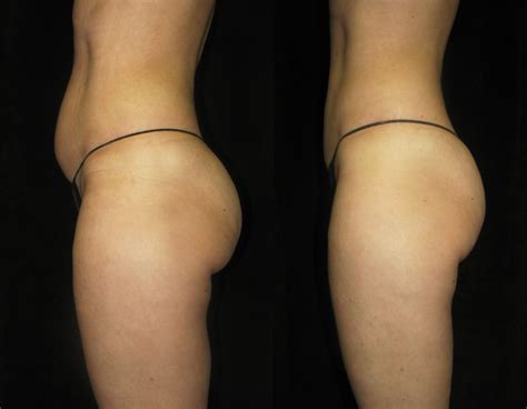 Before And After Lipo Light Focus On Stomach Upper Thigh Buttocks