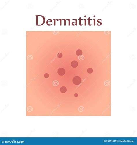 Dermatitis On Human Skin With Itching Pain And Rash Cartoon Vector