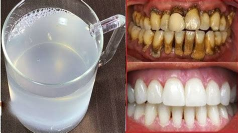 Plaque is the reason why we brush our teeth every day. In 2 Minutes, Whiten Yellow Teeth and Remove Dental Plaque ...