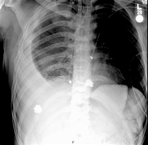 Chest X Ray Taken In The Trauma Bay Showing Bullet Shrapnel Overlying