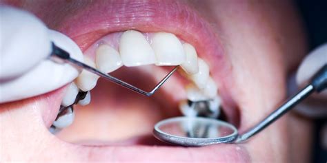 How Can You Get Rid Of Cavities—and Is That Even Possible