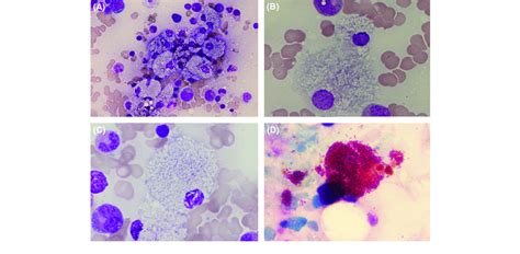 Wright Staining Of The Bone Marrow Aspirate Showing Infiltration By