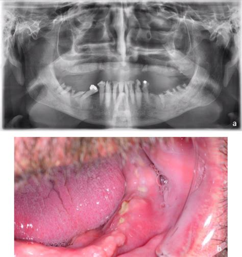 Osteonecrosis Of The Jaw In Patients With Inflammatory Bowel Disease