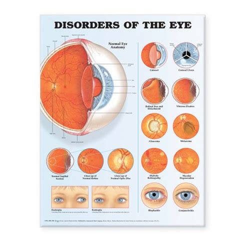 Buy Disorders Of The Eye Anatomical Chart Online At Desertcartuae