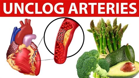 which is the best foods to eat to avoid plaque buildup in arteries how to remove plaque buildup