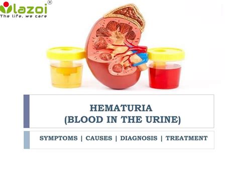 Ppt Hematuria Blood In The Urine Symptoms Causes Diagnosis And