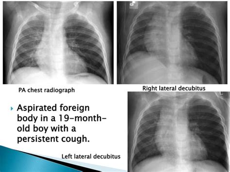 Unilateral Hyperlucent Lung In Children