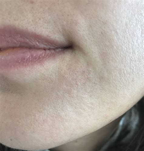 Skin Concerns Patch Of Bumpy Rough Skin In Chin Rskincareaddiction