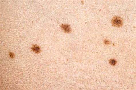 What Are The Symptoms Of Skin Cancer Cdc