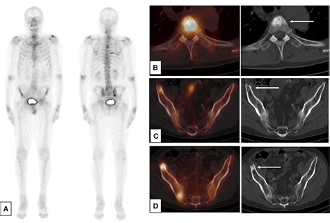 Metastatic Prostate Cancer Diagnosis And Treatment Application Of A Novel Machine Learning