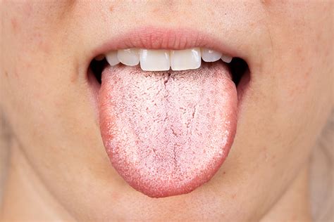11 Reasons For A White Tongue And Treatments